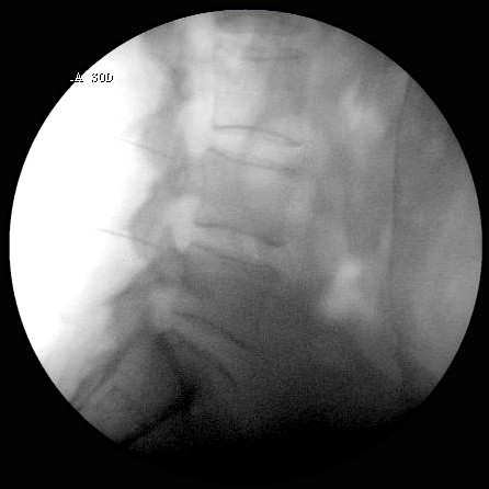 Imagen de fluoroscopia durante un procedimiento de radiofrecuencia lumbar.