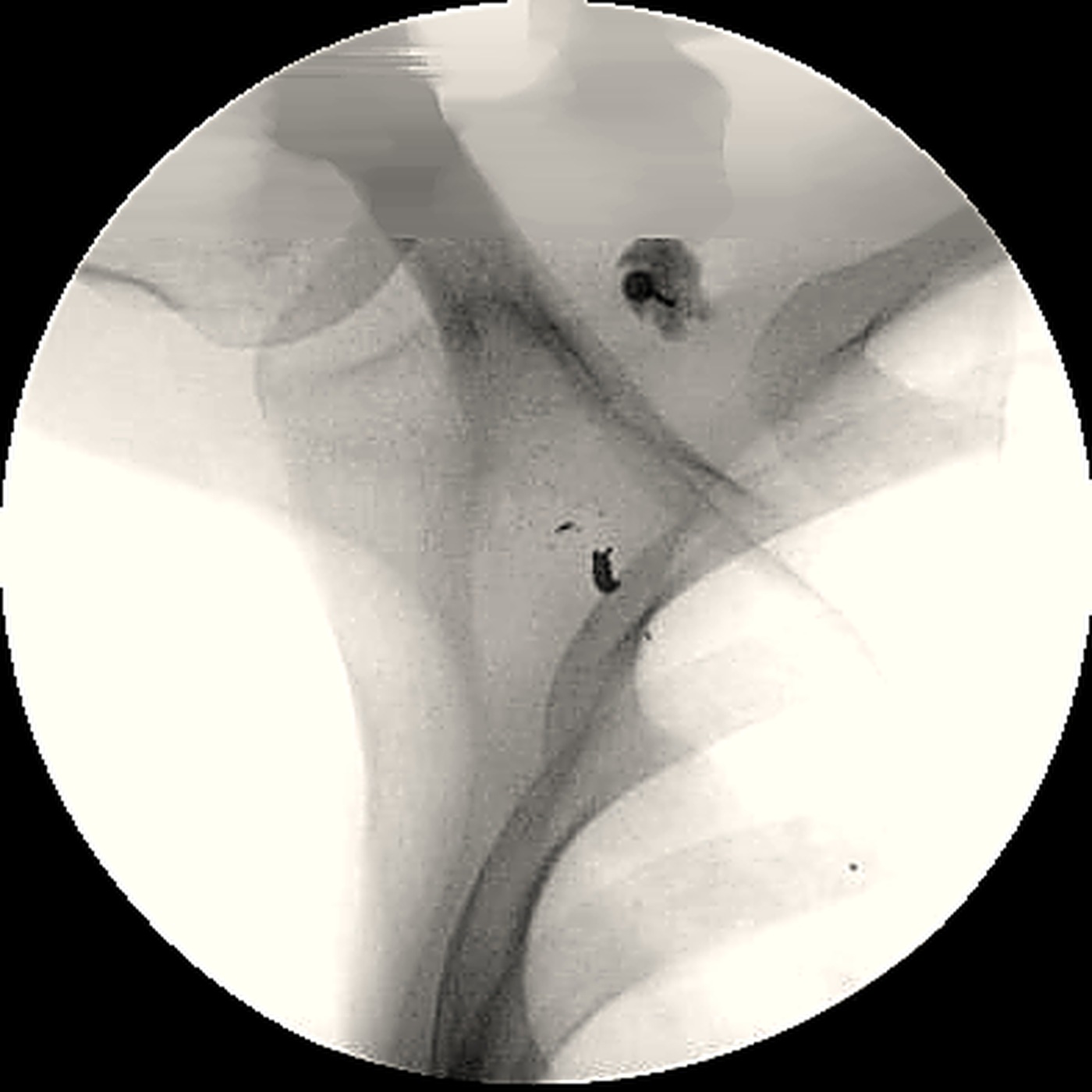 Fluoroscopia anonimizada durante un bloqueo intra articular.
