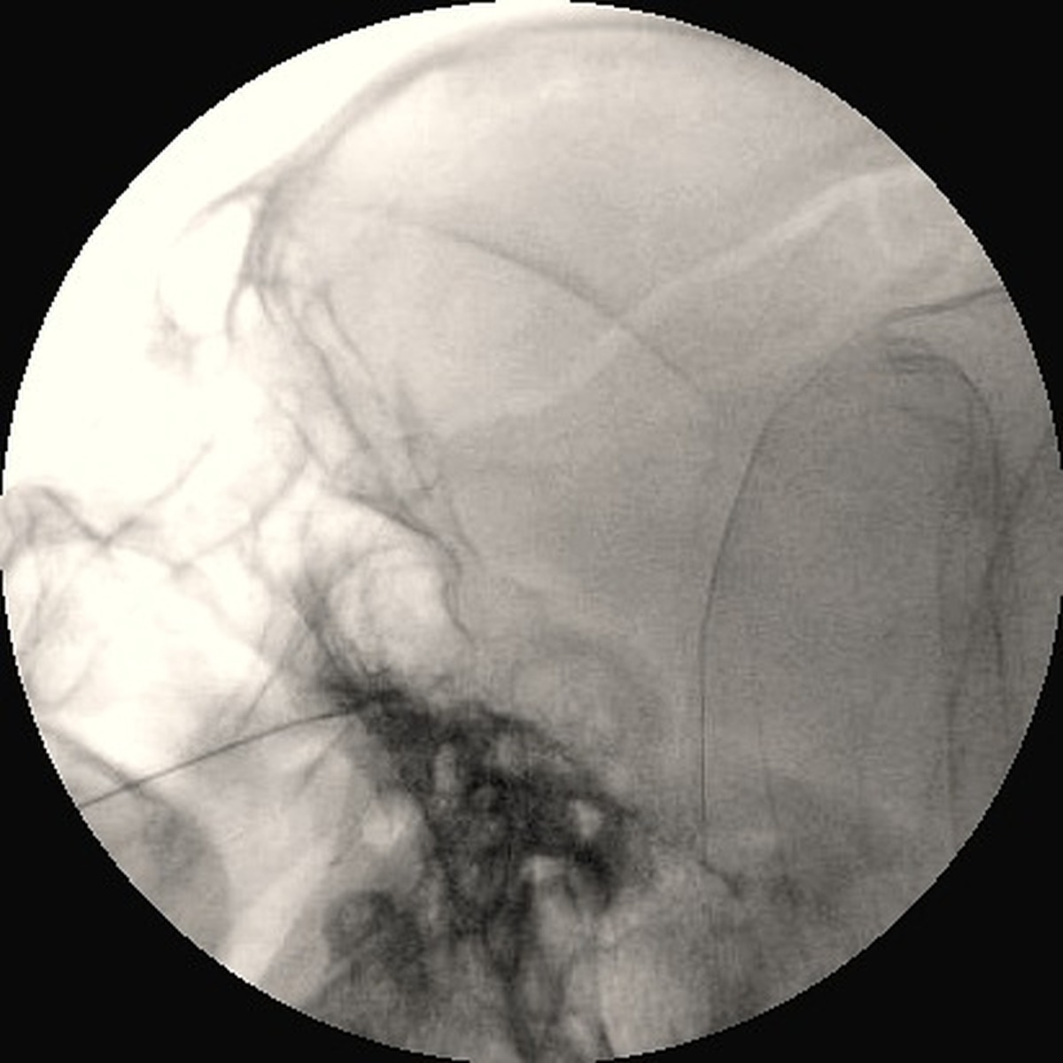 Fluoroscopia del bloqueo del nervio trigémino realizado por el Dr. René Rodríguez.