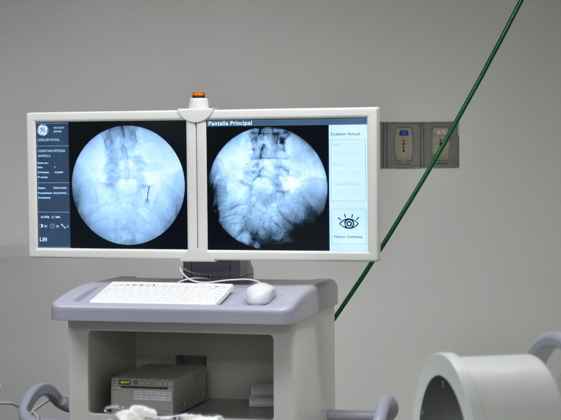 Imágenes de fluoroscopia durante un bloqueo nervioso, mostrando la guía precisa del procedimiento.