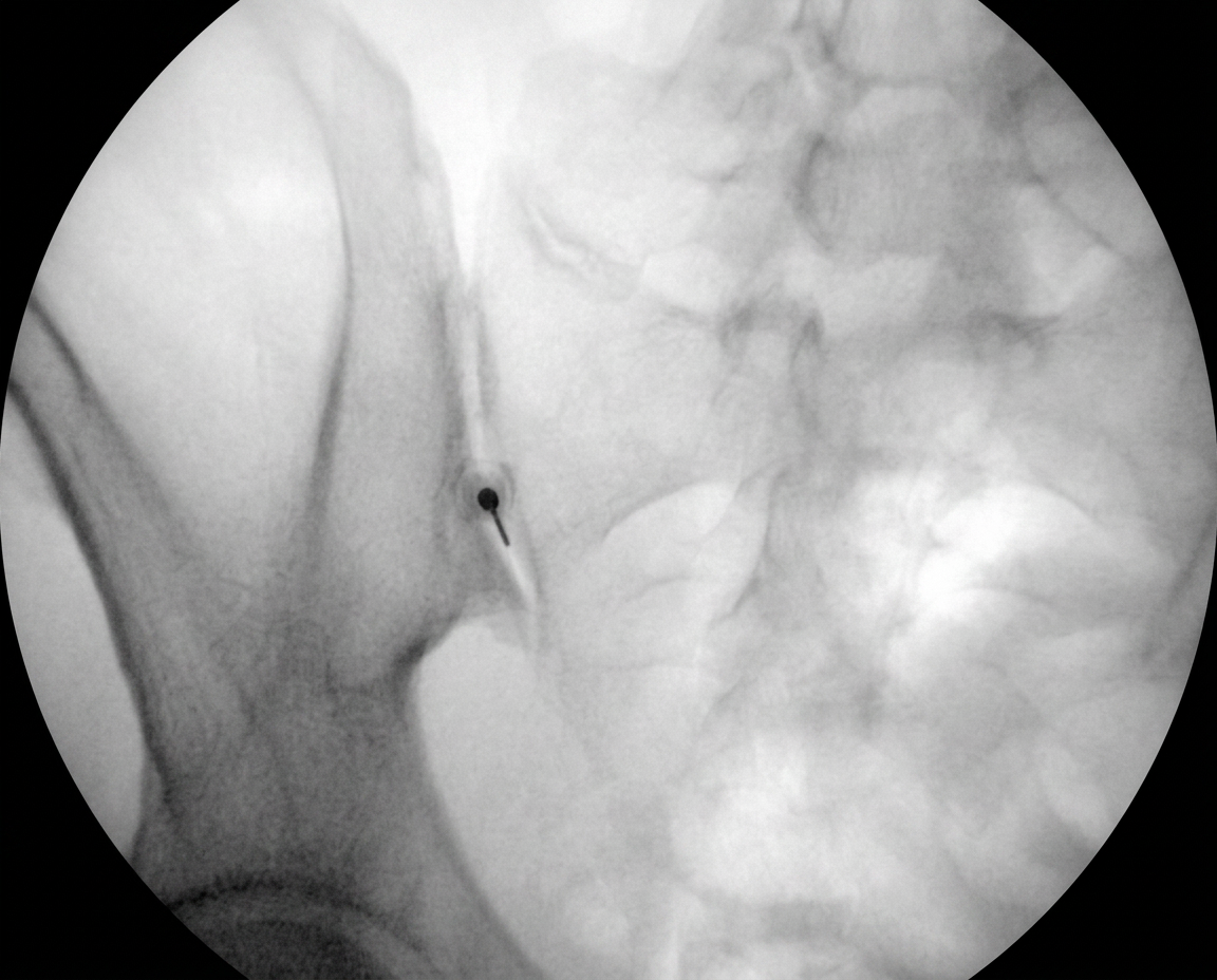 Imagen fluoroscópica de un bloqueo de la articulación sacroiliaca guiado por rayos X.